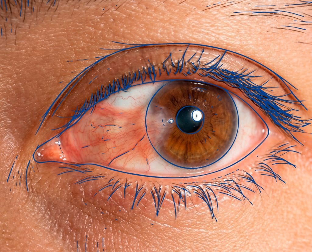 Cirugía de Pterigión - Fundonal