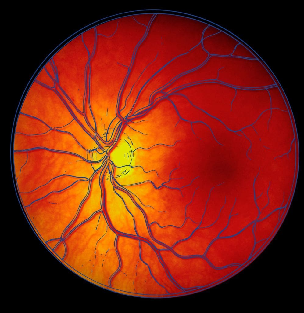 Cirugía de Retina - Fundonal