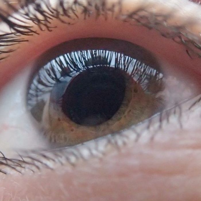 Queratocono, enfermedad progresiva de la córnea