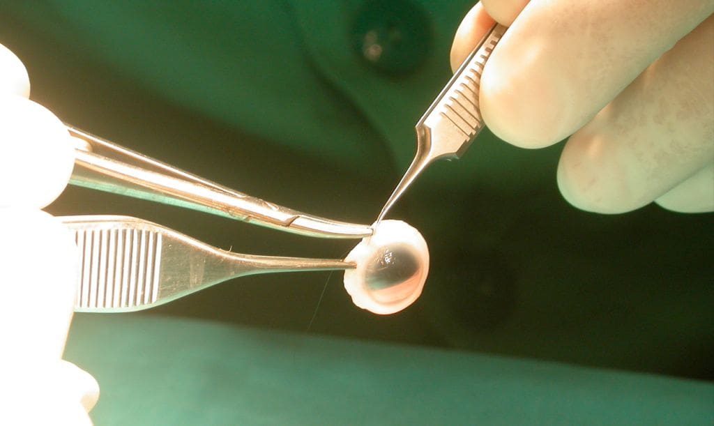 Un trasplante que cambió su vida